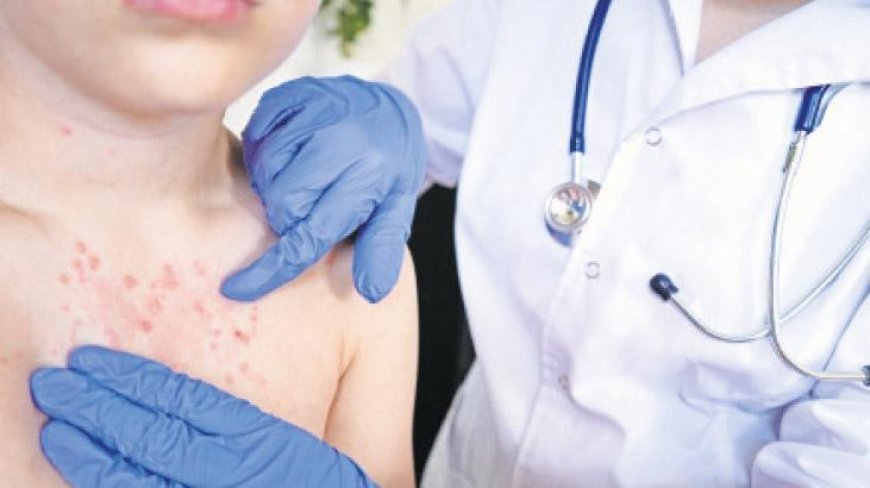 Geri mi dönüyor? Su çiçeği vakalarında artış