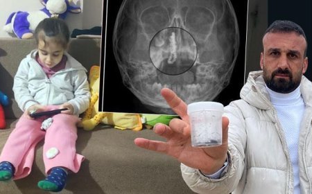 5 yaşındaki Polen, 2 yıldır burnunda taşıyordu! Akılalmaz olay: Nasıl görülmez?