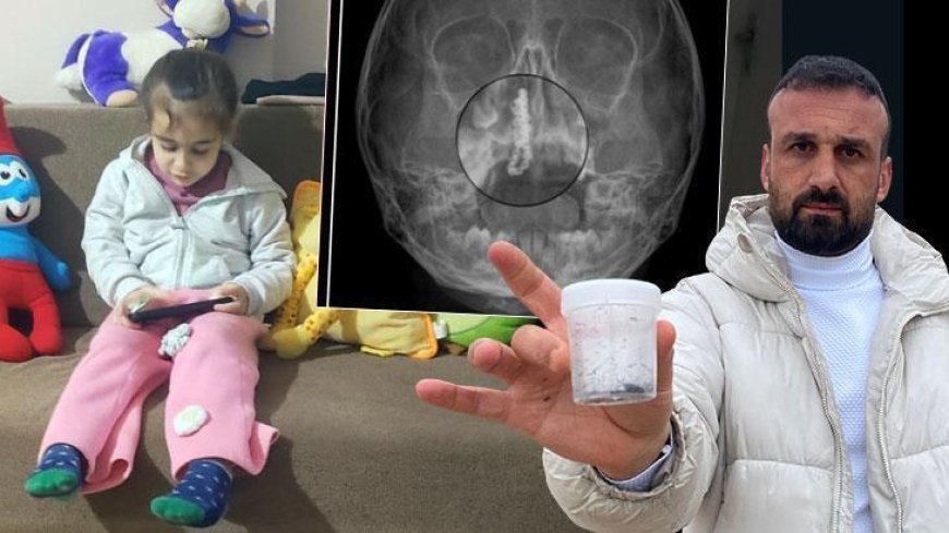 5 yaşındaki Polen, 2 yıldır burnunda taşıyordu! Akılalmaz olay: Nasıl görülmez?