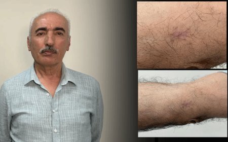 Kolundaki 1 santimetrelik yara aylarca geçmedi! Hastanede gerçeği öğrenince şoke oldu